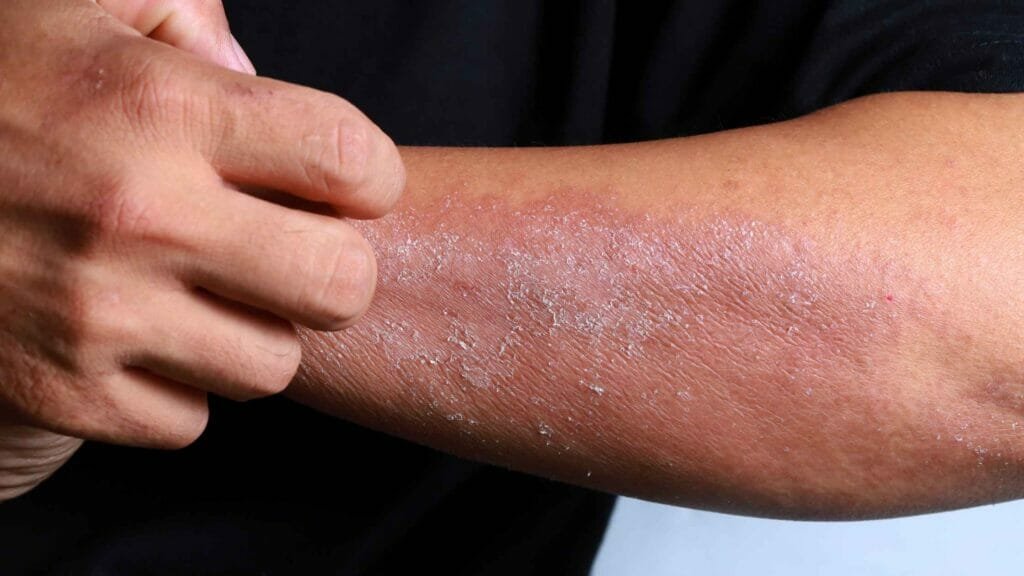 Himalayan Salt for Eczema